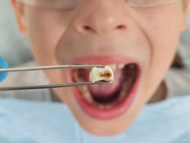 Best Emergency Dental Care for Broken or Chipped Teeth in Memphis, TN