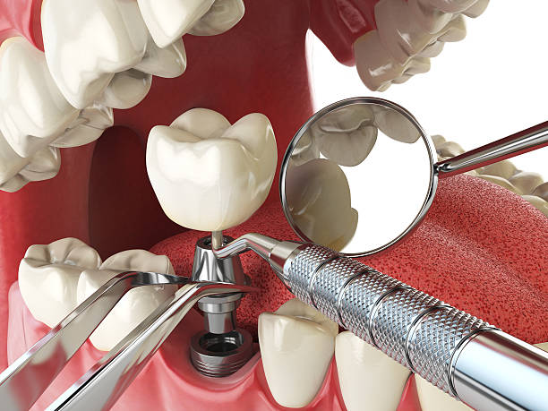 Best Urgent Care for Lost Fillings or Crowns in Memphis, TN